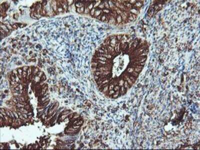 Immunohistochemistry: ATG3/APG3 Antibody (OTI3H2) - Azide and BSA Free [NBP2-72140] - Staining of paraffin-embedded Adenocarcinoma of Human endometrium tissue using anti-Apg3 mouse monoclonal antibody.