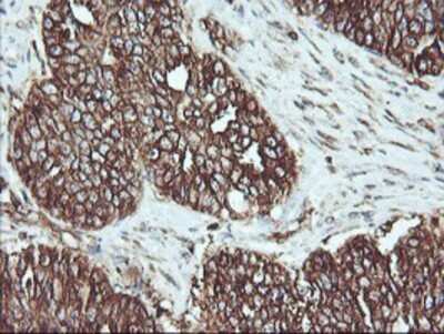 Immunohistochemistry: ATG3/APG3 Antibody (OTI3H2) - Azide and BSA Free [NBP2-72140] - Staining of paraffin-embedded Adenocarcinoma of Human ovary tissue using anti-Apg3 mouse monoclonal antibody.