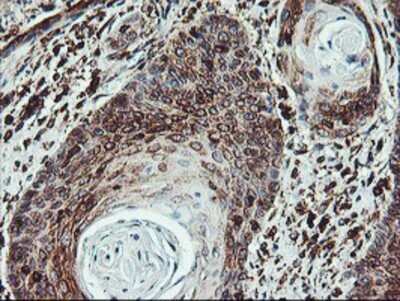 Immunohistochemistry: ATG3/APG3 Antibody (OTI3H2) - Azide and BSA Free [NBP2-72140] - Staining of paraffin-embedded Carcinoma of Human bladder tissue using anti-Apg3 mouse monoclonal antibody.