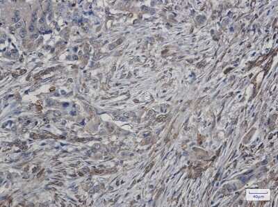 Immunohistochemistry-Paraffin: ATG4C Antibody (S08-8G9) [NBP3-15003] - Immunohistochemistry of ATG4C in paraffin-embedded Human lung cancer tissue using ATG4C Rabbit mAb at dilution 1/50