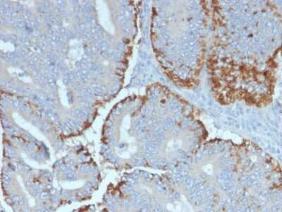 Immunohistochemistry-Paraffin: ATG5 Antibody (ATG5/2492) - Azide and BSA Free [NBP3-08433] - Formalin-fixed, paraffin-embedded human Colon Carcinoma stained with ATG5 Mouse Monoclonal Antibody (ATG5/2492).