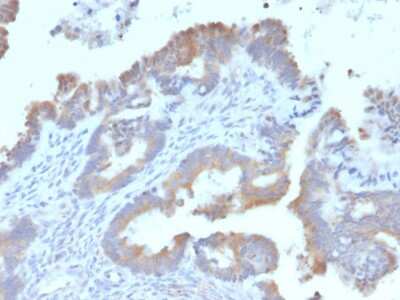 Immunohistochemistry-Paraffin: ATG5 Antibody (ATG5/2492) - Azide and BSA Free [NBP3-08433] - Formalin-fixed, paraffin-embedded human Endometrial Carcinoma stained with ATG5 Mouse Monoclonal Antibody (ATG5/2492).