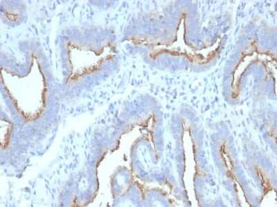 Immunohistochemistry-Paraffin: ATG5 Antibody (ATG5/2492) - Azide and BSA Free [NBP3-08433] - Formalin-fixed, paraffin-embedded human Ovarian Carcinoma stained with ATG5 Mouse Monoclonal Antibody (ATG5/2492).