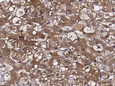 Immunohistochemistry-Paraffin: ATOX1 Antibody [NBP2-97082] - Staining of human ATOX1 in human hepatoma with rabbit polyclonal antibody (1:1000).