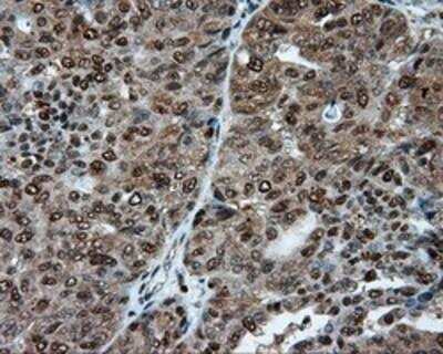 Immunohistochemistry-Paraffin: ATP Citrate Lyase Antibody (OTI3G8) [NBP2-02410] -  Staining of paraffin-embedded Adenocarcinoma of endometrium tissue using anti-ATP Citrate Lyase mouse monoclonal antibody.