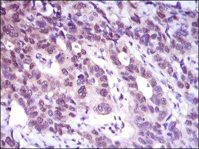 Immunohistochemistry-Paraffin: ATP Citrate Lyase Antibody (5F8D11) [NBP2-37429] - Analysis of paraffin-embedded esophageal cancer tissues using ACLY mouse mAb with DAB staining.