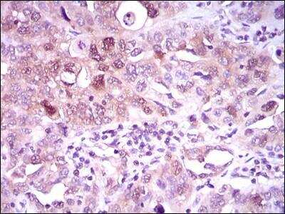 Immunohistochemistry-Paraffin: ATP Citrate Lyase Antibody (5F8D11) [NBP2-37429] - Analysis of paraffin-embedded endometrial cancer tissues using ACLY mouse mAb with DAB staining.