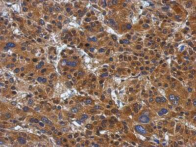 Immunohistochemistry-Paraffin: ATP Citrate Lyase Antibody [NBP2-15510] - Immunohistochemical analysis of paraffin-embedded Hepatoma, using antibody at 1:500 dilution.