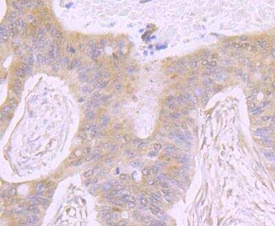 Immunohistochemistry-Paraffin: ATP Citrate Lyase Antibody [NBP3-09061] - Immunohistochemical analysis of paraffin-embedded human colon cancer tissue using anti-ATP citrate lyase antibody. Counter stained with hematoxylin.