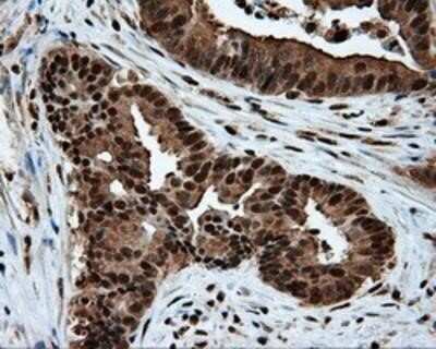 Immunohistochemistry: ATP Citrate Lyase Antibody (OTI3G8) - Azide and BSA Free [NBP2-70073] - Staining of paraffin-embedded Adenocarcinoma of colon tissue using anti-ATP Citrate Lyase mouse monoclonal antibody.