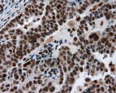 Immunohistochemistry-Paraffin: ATP Citrate Lyase Antibody (OTI3G8) [NBP2-02410] - Staining of paraffin-embedded Adenocarcinoma of ovary tissue. Heat-induced epitope retrieval by 10mM citric buffer, pH6.0, 100C for 10min, Dilution 1:50.