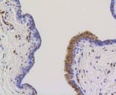 Immunohistochemistry-Paraffin: ATP Citrate Lyase Antibody (ST51-07) [NBP2-67509] - Analysis of human breast carcinoma tissue using anti-ATP citrate lyase antibody. Counter stained with hematoxylin.