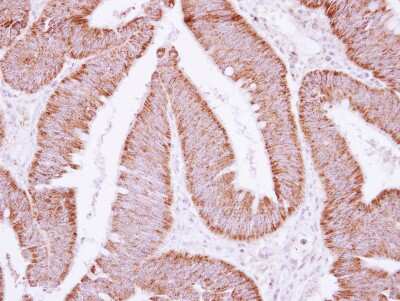 Immunohistochemistry-Paraffin: ATP5F1 Antibody [NBP2-15513] - Immunohistochemical analysis of paraffin-embedded Colon ca, using antibody at 1:250 dilution.