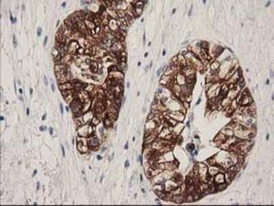 Immunohistochemistry: ATP6V1B1 Antibody (OTI1H6) - Azide and BSA Free [NBP2-70237] - Staining of paraffin-embedded Adenocarcinoma of Human ovary tissue using anti-ATP6V1B1 mouse monoclonal antibody.