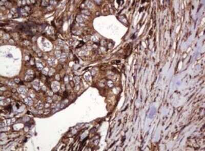 Immunohistochemistry: ATP6V1B2 Antibody (OTI1E11) - Azide and BSA Free [NBP2-70238] - Analysis of Adenocarcinoma of Human breast tissue. (Heat-induced epitope retrieval by 10mM citric buffer, pH6.0, 120C for 3min)