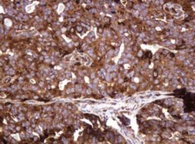 Immunohistochemistry: ATP6V1B2 Antibody (OTI1E11) - Azide and BSA Free [NBP2-70238] - Analysis of Adenocarcinoma of Human ovary tissue. (Heat-induced epitope retrieval by 10mM citric buffer, pH6.0, 120C for 3min)