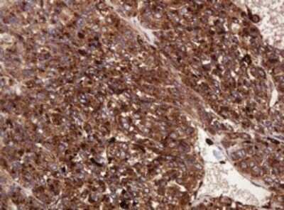 Immunohistochemistry: ATP6V1B2 Antibody (OTI1E11) - Azide and BSA Free [NBP2-70238] - Analysis of Carcinoma of Human liver. (Heat-induced epitope retrieval by 10mM citric buffer, pH6.0, 120C for 3min)