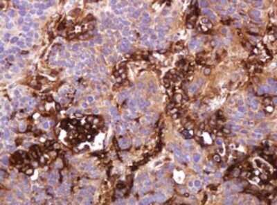 Immunohistochemistry: ATP6V1B2 Antibody (OTI1E11) - Azide and BSA Free [NBP2-70238] - Analysis of Carcinoma of Human lung tissue. (Heat-induced epitope retrieval by 10mM citric buffer, pH6.0, 120C for 3min)