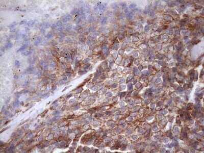 Immunohistochemistry: ATP6V1C2 Antibody (OTI8H4) - Azide and BSA Free [NBP2-72465] - Analysis of Adenocarcinoma of Human breast tissue. (Heat-induced epitope retrieval by 1mM EDTA in 10mM Tris buffer (pH8.5) at 120C for 3 min)