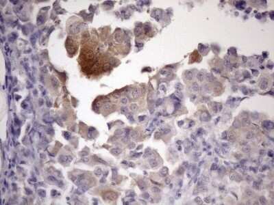 Immunohistochemistry: ATP6V1C2 Antibody (OTI8H4) - Azide and BSA Free [NBP2-72465] - Analysis of Adenocarcinoma of Human endometrium tissue. (Heat-induced epitope retrieval by 1mM EDTA in 10mM Tris buffer (pH8.5) at 120C for 3 min)