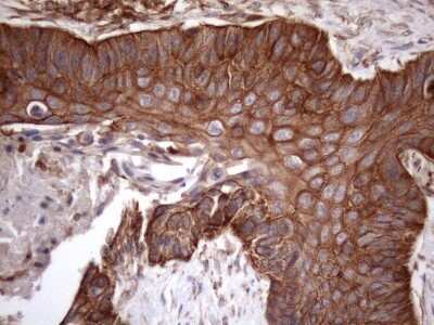 Immunohistochemistry: ATP6V1C2 Antibody (OTI8H4) - Azide and BSA Free [NBP2-72465] - Analysis of Carcinoma of Human lung tissue.(Heat-induced epitope retrieval by 1mM EDTA in 10mM Tris buffer (pH8.5) at 120C for 3 min)