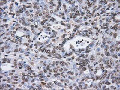 Immunohistochemistry-Paraffin: ATPB Antibody (4E5) [NBP2-02249] - Staining of paraffin-embedded Adenocarcinoma of endometrium tissue using anti-ATPB mouse monoclonal antibody.