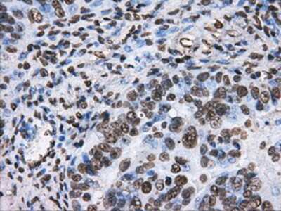 Immunohistochemistry-Paraffin: ATPB Antibody (4E5) [NBP2-02249] - Staining of paraffin-embedded Adenocarcinoma of ovary tissue using anti-ATPBmouse monoclonal antibody.