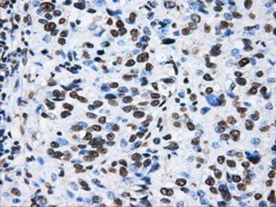 Immunohistochemistry-Paraffin: ATPB Antibody (4E5) [NBP2-02249] - Staining of paraffin-embedded Carcinoma of bladder tissue using anti-ATPB mouse monoclonal antibody.