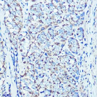 Immunohistochemistry-Paraffin: ATPB Antibody (9A1O2) [NBP3-15354] - Immunohistochemistry of paraffin-embedded human esophageal cancer using ATPB Rabbit mAb (NBP3-15354) at dilution of 1:100 (40x lens).Perform microwave antigen retrieval with 10 mM PBS buffer pH 7.2 before commencing with IHC staining protocol.