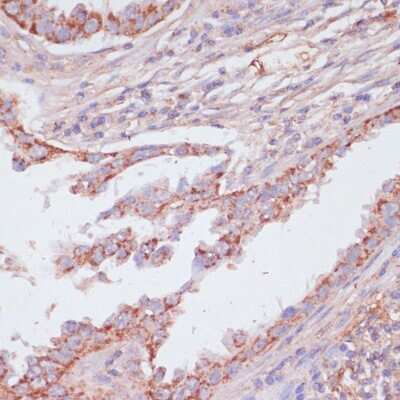 Immunohistochemistry-Paraffin: ATPG Antibody [NBP2-92867] - Paraffin-embedded human lung cancer using ATPG .