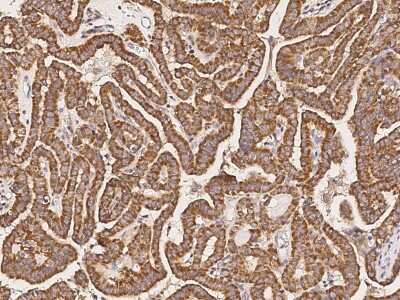 Immunohistochemistry-Paraffin: ATPase Inhibitory Factor 1 Antibody [NBP2-99177] - Immunochemical staining of human ATPase Inhibitory Factor 1 in human thyroid cancer with rabbit polyclonal antibody (1:1000, formalin-fixed paraffin embedded sections).