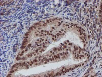 Immunohistochemistry-Paraffin: ATRIP Antibody (OTI5E7) [NBP2-02004] - Staining of paraffin-embedded Adenocarcinoma of Human endometrium tissue using anti-ATRIP mouse monoclonal antibody.