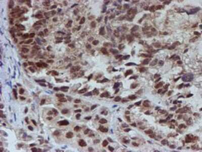 Immunohistochemistry-Paraffin: ATRIP Antibody (OTI5E7) [NBP2-02004] - Staining of paraffin-embedded Adenocarcinoma of Human ovary tissue using anti-ATRIP mouse monoclonal antibody.