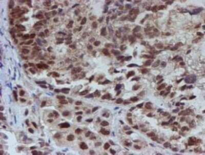 Immunohistochemistry: ATRIP Antibody (OTI5E7) - Azide and BSA Free [NBP2-72271] - Staining of paraffin-embedded Adenocarcinoma of Human ovary tissue using anti-ATRIP mouse monoclonal antibody.