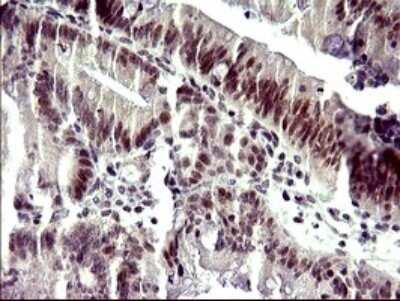 Immunohistochemistry: ATXN7L1 Antibody (OTI4F6) - Azide and BSA Free [NBP2-72464] - Analysis of Carcinoma of Human pancreas tissue. (Heat-induced epitope retrieval by 10mM citric buffer, pH6.0, 120C for 3min)