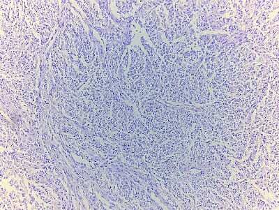 Hematoxylin & Eosin Stain: Abdominal Tissue Slides (Neurofibromatosis) [NBP2-77854] - Tissue: Human Abdomen,  Pathology: Neurofibromatosis