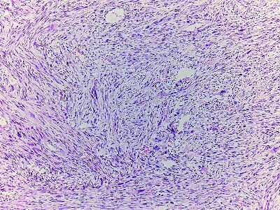 Hematoxylin & Eosin Stain: Abdominal Tissue Slides (Tumor) [NBP2-77942] - Tissue: Human Abdomen,  Pathology: Leiomyosarcoma