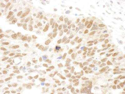 Immunohistochemistry: Abraxas Antibody [NBP1-22978] - Sample: FFPE section of human ovarian carcinoma. Antibody used at a dilution of 1:250. Detection: DAB staining using Immunohistochemistry Accessory Kit