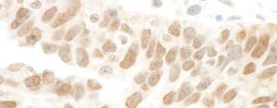 Immunohistochemistry: Abraxas Antibody [NBP1-22978] - Sample: FFPE section of human ovarian carcinoma. Antibody: Affinity purified rabbit anti-Abraxas used at a dilution of 1:1,000 ( 1ug/ml). Detection: DAB staining using Immunohistochemistry Accessory Kit .
