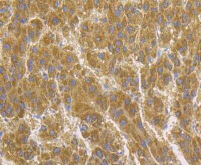 Immunohistochemistry-Paraffin: Acetyl-CoA Carboxylase alpha/ACACA Antibody [NBP2-89114] - Analysis of paraffin-embedded human liver tissue using anti-Acetyl CoA Carboxylase 1 (ACC1) antibody. The section was pre-treated using heat mediated antigen retrieval with Tris-EDTA buffer (pH 8.0-8.4) for 20 minutes.The tissues were blocked in 5% BSA for 30 minutes at room temperature, washed with ddH2O and PBS, and then probed with the antibody at 1/200 dilution, for 30 minutes at room temperature and detected using an HRP conjugated compact polymer system. DAB was used as the chrogen. Counter stained with hematoxylin and mounted with DPX.