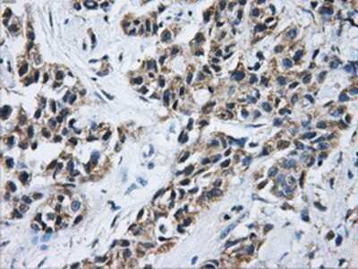 Immunohistochemistry-Paraffin: Aconitase 2 Antibody (3G8) [NBP2-02241] - Staining of paraffin-embedded Adenocarcinoma of breast tissue using anti-Aconitase 2 mouse monoclonal antibody.