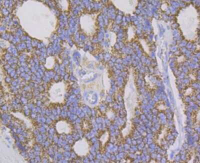 Immunohistochemistry-Paraffin: Aconitase 2 Antibody (JE40-83) [NBP2-75394] - Analysis of paraffin-embedded human prostate cancer tissue using anti-Aconitase 2 antibody. Counter stained with hematoxylin.