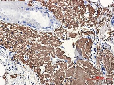 Immunohistochemistry-Paraffin: Aconitase 2 Antibody (S07-7A1) [NBP3-19829] - Immunohistochemical of Aconitase 2 in Human breast cancer tissue using NBP3-19829 at dilution 1/50