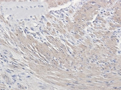 Immunohistochemistry-Paraffin: Actin Antibody (S05-4F6) [NBP3-19993] - Immunohistochemistry of Actin in paraffin-embedded Human colon cancer tissue using NBP3-19993 at dilution 1/50