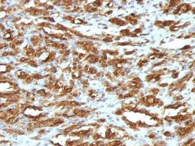 Immunohistochemistry-Paraffin: Actin (Muscle Specific) Antibody (HHF35) - IHC-Prediluted [NBP2-48154] - Human Rhabdomyosarcoma stained with Muscle Specific Actin Mouse Monoclonal Antibody (HHF35).