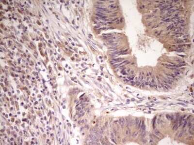 Immunohistochemistry: Activin RIIA Antibody (5D1) [NBP2-46491] - Analysis of Adenocarcinoma of Human colon tissue. (Heat-induced epitope retrieval by 1 mM EDTA in 10mM Tris, pH8.5, 120C for 3min)