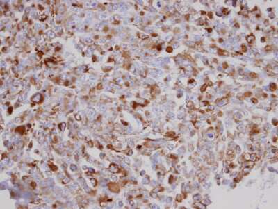 Immunohistochemistry-Paraffin: Acylglycerol Kinase Antibody [NBP1-32163] - Paraffin-embedded H1299 xenograft, using antibody at 1:100 dilution.