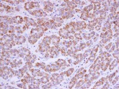 Immunohistochemistry-Paraffin: Acylglycerol Kinase Antibody [NBP1-32163] - Acylglycerol kinase antibody detects Acylglycerol kinase protein at cytoplasm in human hepatocellular carcinoma by immunohistochemical analysis. Sample: Paraffin-embedded human hepatocellular carcinoma. Acylglycerol kinase antibody diluted at 1:500.