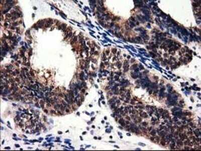 Immunohistochemistry: Adenylosuccinate Lyase Antibody (OTI2D10) - Azide and BSA Free [NBP2-70101] - Staining of paraffin-embedded Adenocarcinoma of Human endometrium tissue using anti-Adenylosuccinate Lyase mouse monoclonal antibody.