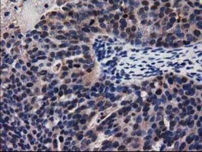 Immunohistochemistry: Adenylosuccinate Lyase Antibody (OTI2D10) - Azide and BSA Free [NBP2-70101] - Staining of paraffin-embedded Adenocarcinoma of Human ovary tissue using anti-Adenylosuccinate Lyase mouse monoclonal antibody.